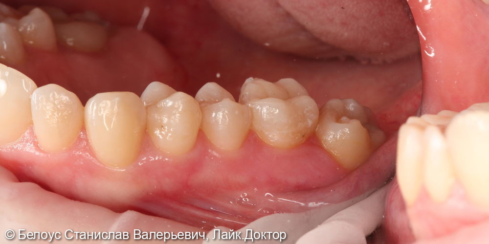 Восстановление зуба керамической вкладкой CEREC - фото №4