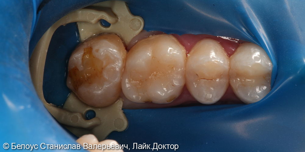 Лечение кариеса в 3.6 и 3.7 зубах - фото №1