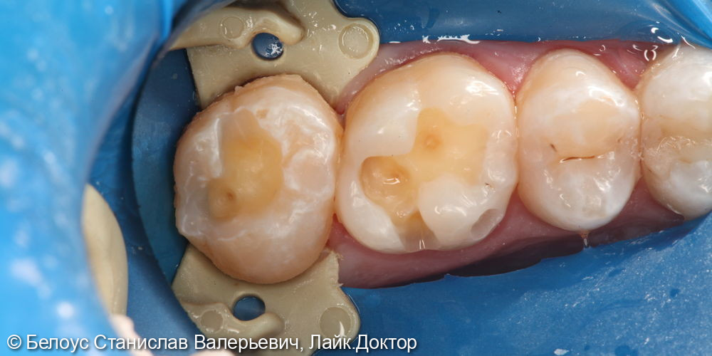 Лечение кариеса в 3.6 и 3.7 зубах - фото №2