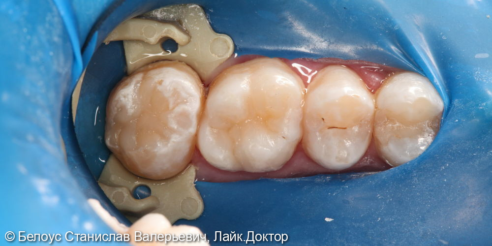 Лечение кариеса в 3.6 и 3.7 зубах - фото №3
