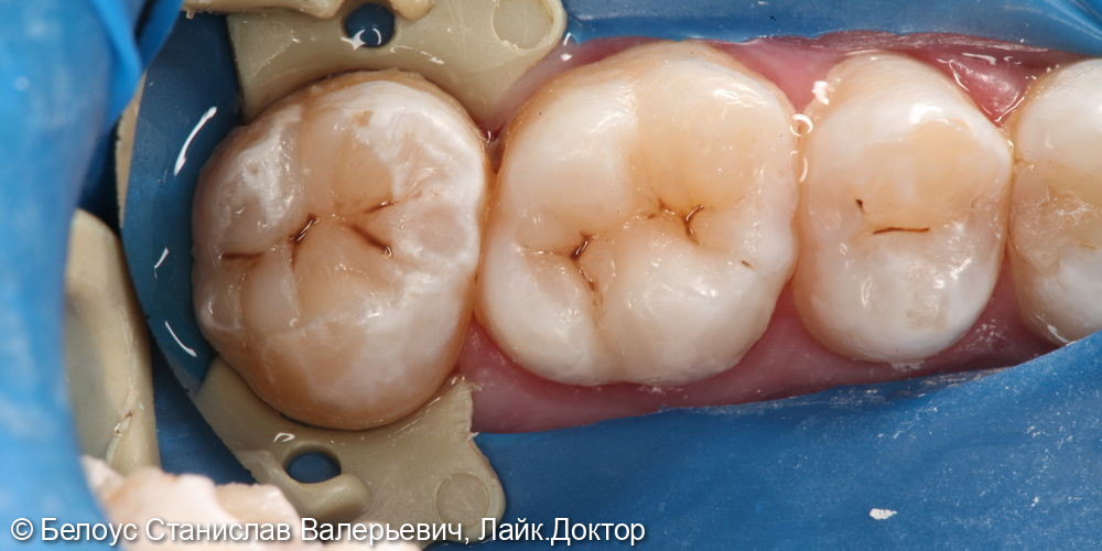 Лечение кариеса в 3.6 и 3.7 зубах - фото №4