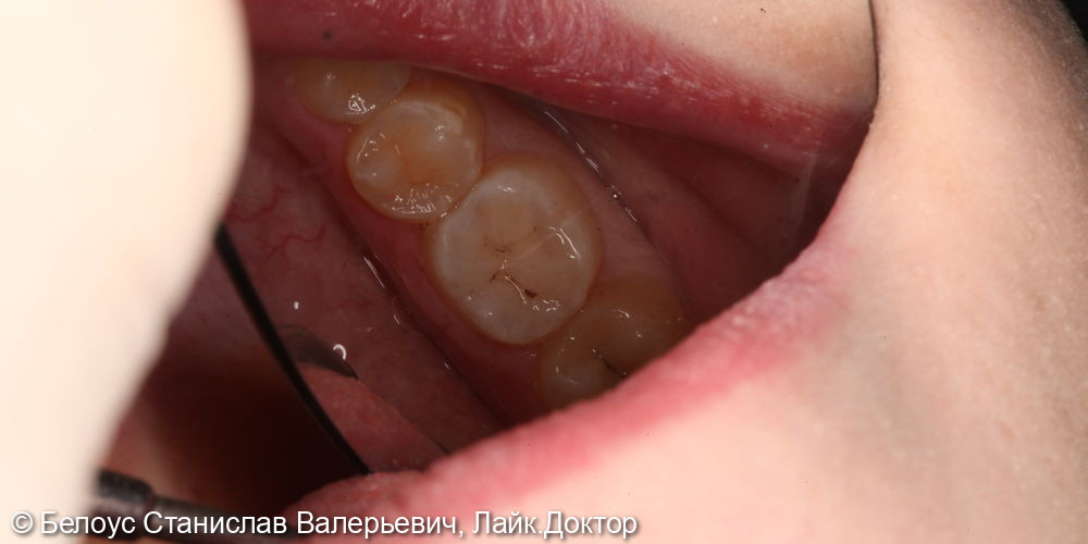 Лечение глубокого кариеса жевательного зуба 3.6 - фото №2