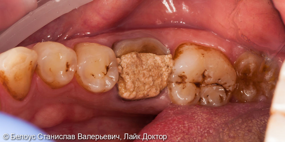 Восстановление 3.6 зуба коронкой CEREC - фото №1
