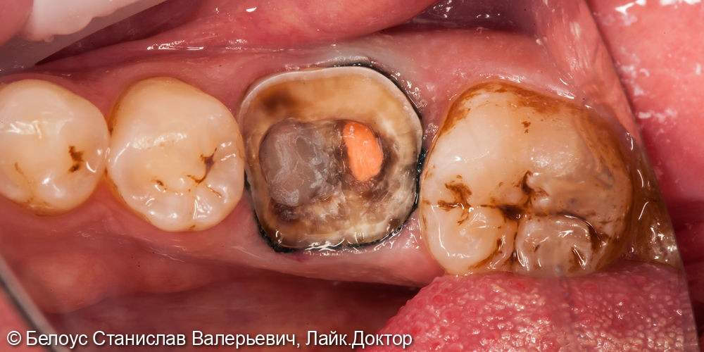 Восстановление 3.6 зуба коронкой CEREC - фото №2