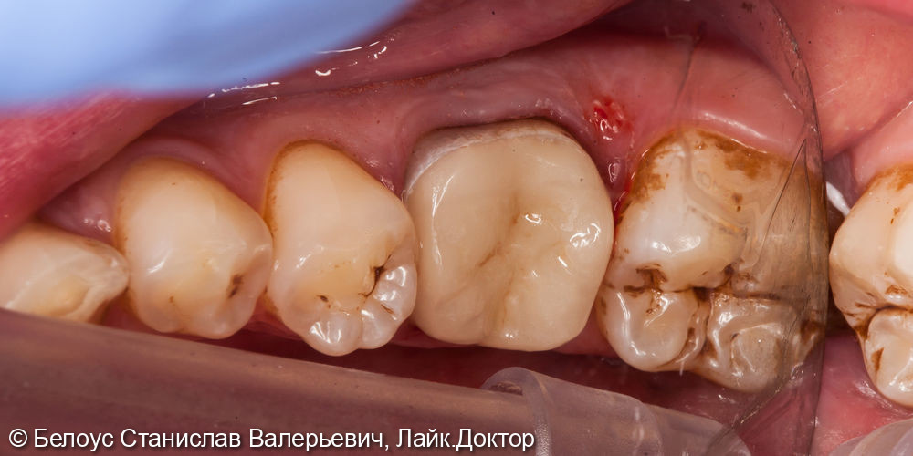 Восстановление 3.6 зуба коронкой CEREC - фото №4