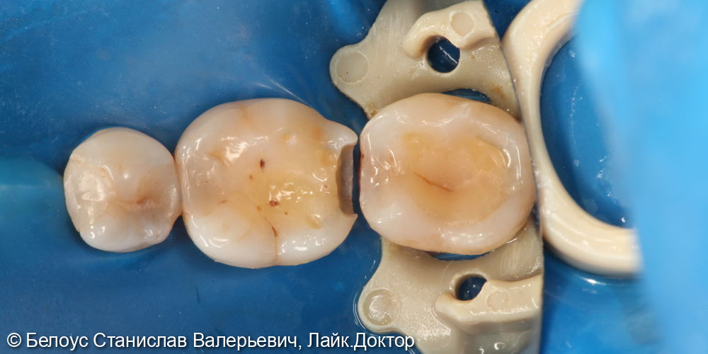 Лечение кариеса на 3.6 зубе - фото №2