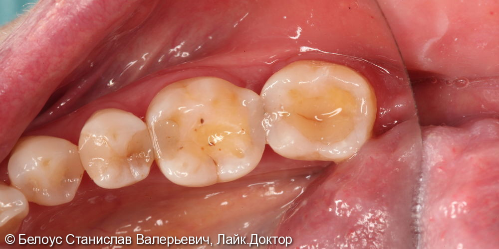 Лечение кариеса на 3.6 зубе - фото №3