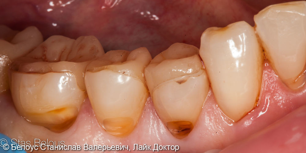 Лечение клиновидных дефектов зубов - фото №1