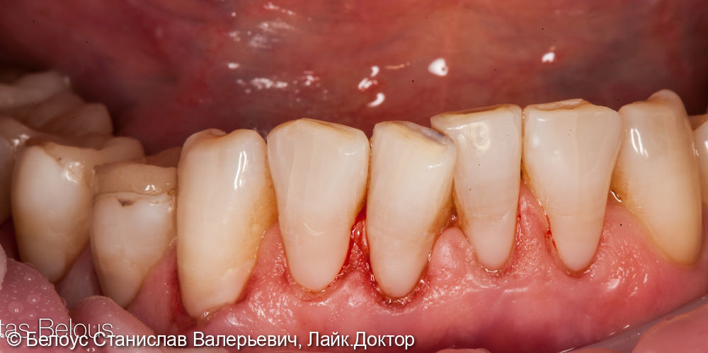 Лечение клиновидных дефектов зубов - фото №3