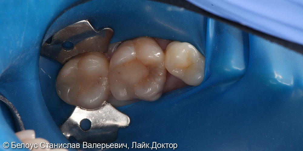 Лечение периодонтита в 2.6 зубе - фото №1