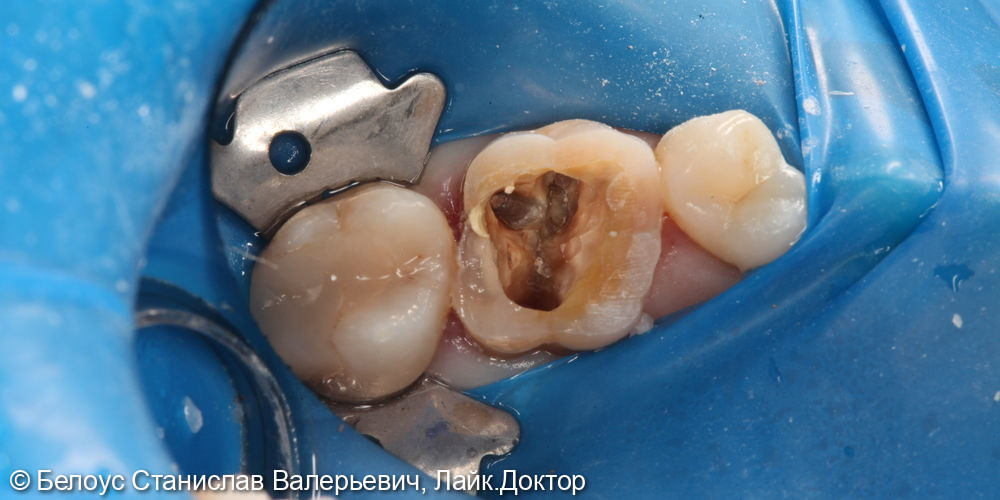 Лечение периодонтита в 2.6 зубе - фото №3