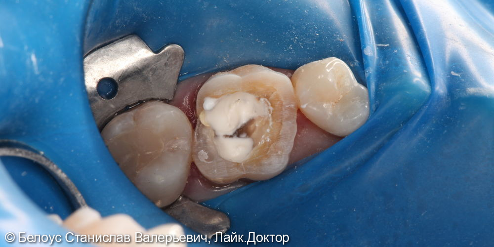 Лечение периодонтита в 2.6 зубе - фото №2