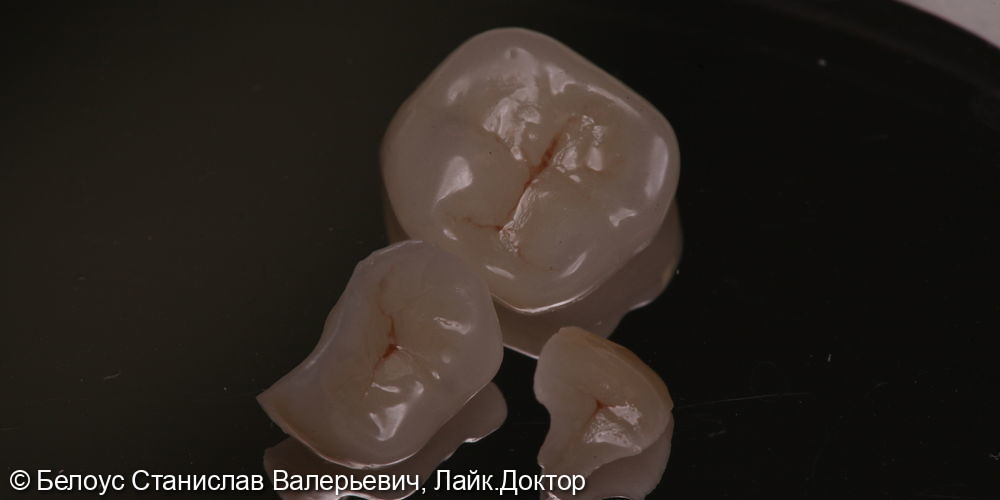 Установка керамических коронок по технологии CEREC в 4.5,4.6,4.7 зубах - фото №3