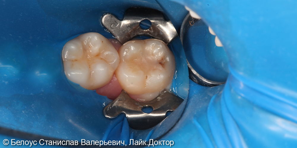 Лечение глубокого кариеса жевательного зуба 4.7 - фото №1