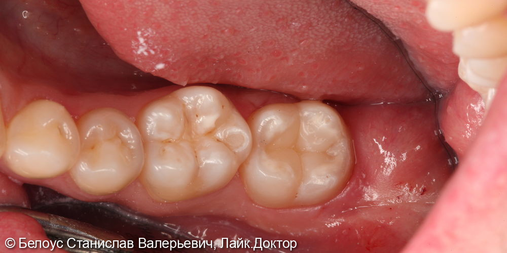 Лечение глубокого кариеса жевательного зуба 4.7 - фото №3