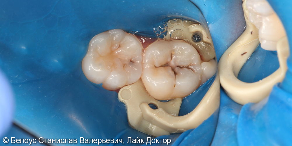 Лечение кариеса на жевательной поверхности 4.6 и 4.7 зуба - фото №1