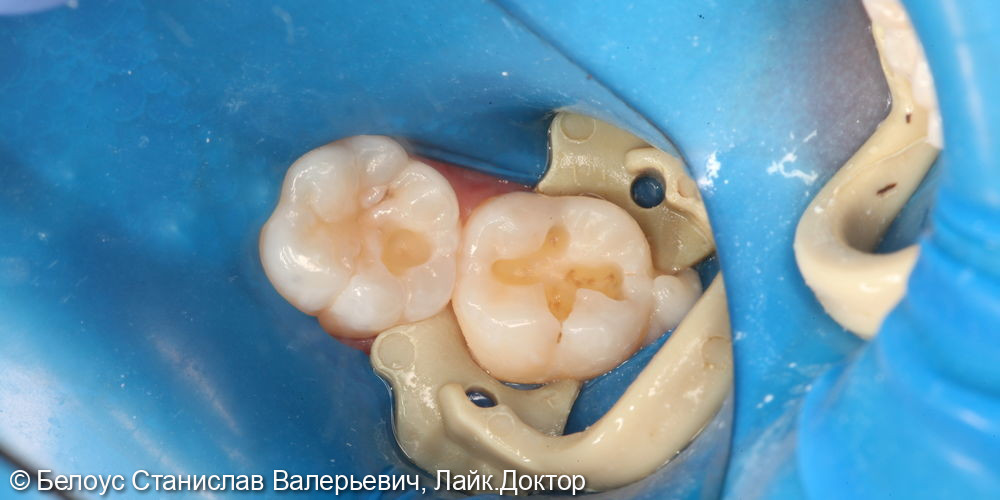 Лечение кариеса на жевательной поверхности 4.6 и 4.7 зуба - фото №2