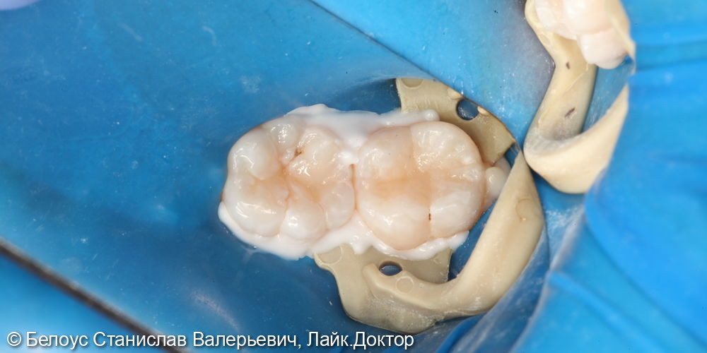 Лечение кариеса на жевательной поверхности 4.6 и 4.7 зуба - фото №3