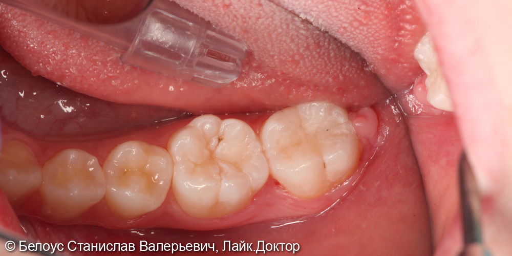 Лечение кариеса на жевательной поверхности 4.6 и 4.7 зуба - фото №4