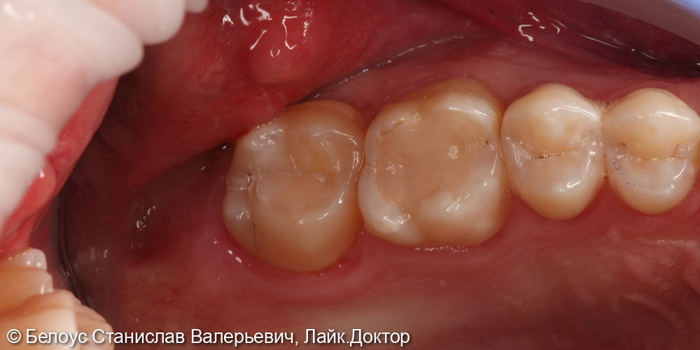 Лечение кариеса на жевательной поверхности 2.7 зуба - фото №4