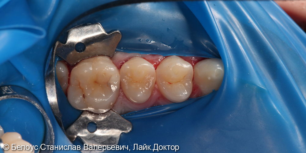 Лечение глубокого кариеса на жевательной поверхности 2.6 зуба - фото №1