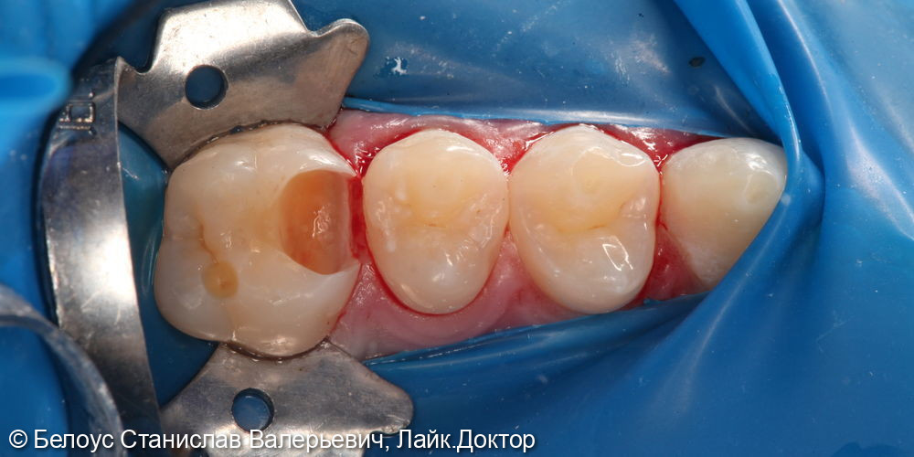 Лечение глубокого кариеса на жевательной поверхности 2.6 зуба - фото №2