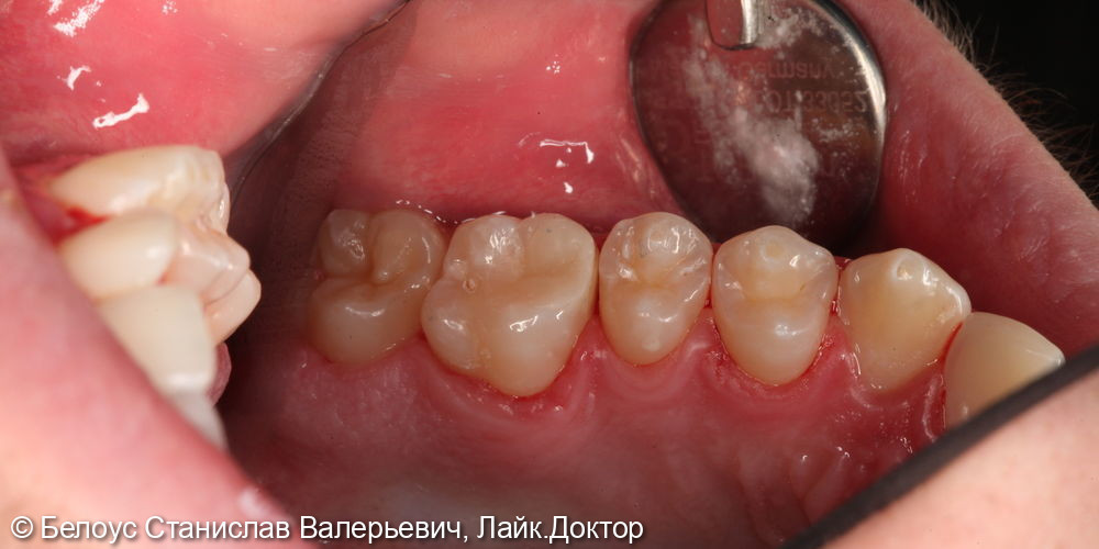 Лечение глубокого кариеса на жевательной поверхности 2.6 зуба - фото №3