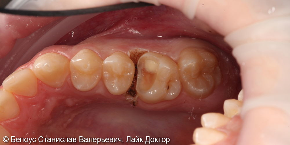 Восстановление зуба керамической коронкой 1.6 - фото №1