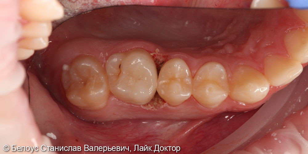 Восстановление зуба керамической коронкой 1.6 - фото №3