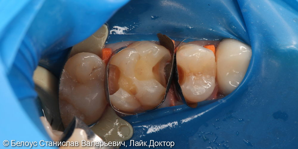 Лечение кариеса на жевательной поверхности 2.5,2.6 зуба - фото №2