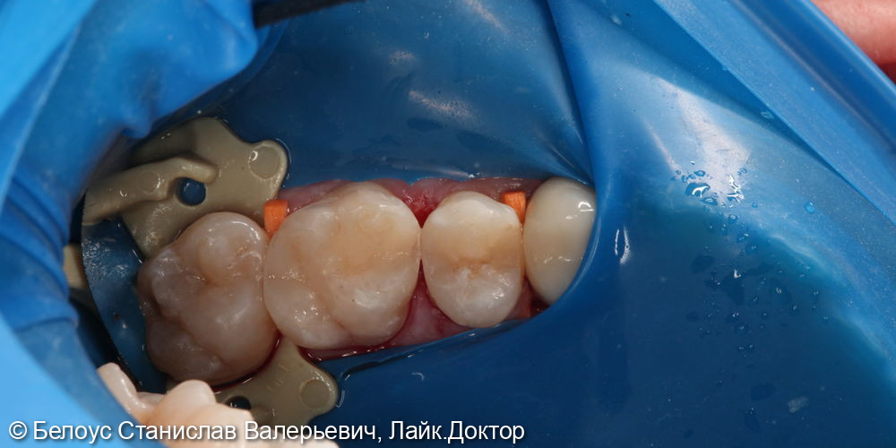 Лечение кариеса на жевательной поверхности 2.5,2.6 зуба - фото №3