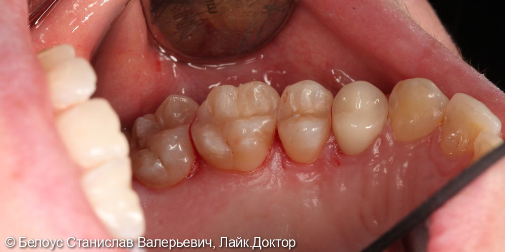 Лечение кариеса на жевательной поверхности 2.5,2.6 зуба - фото №4