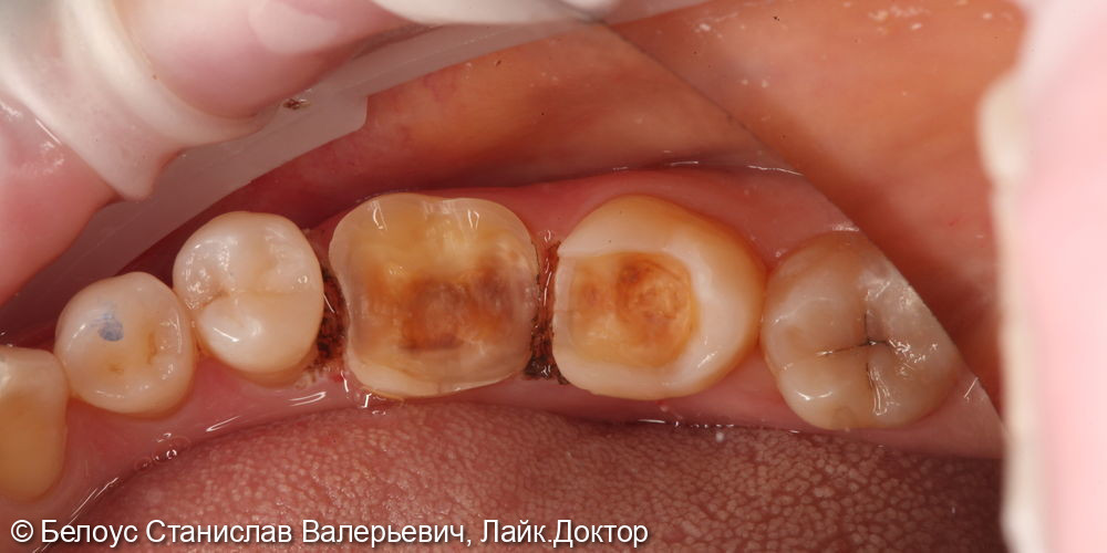 Установка керамических коронок 3.6 и 3.7 зуба - фото №3