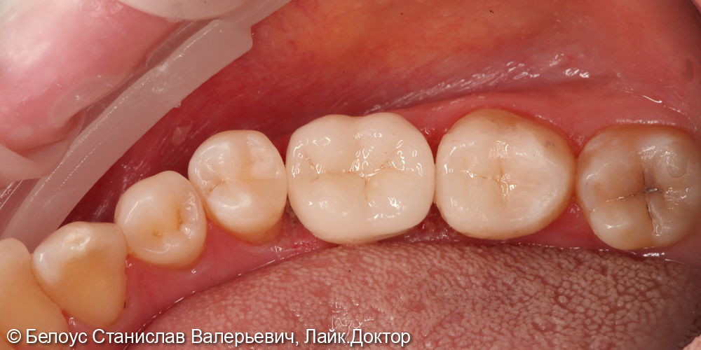 Установка керамических коронок 3.6 и 3.7 зуба - фото №4