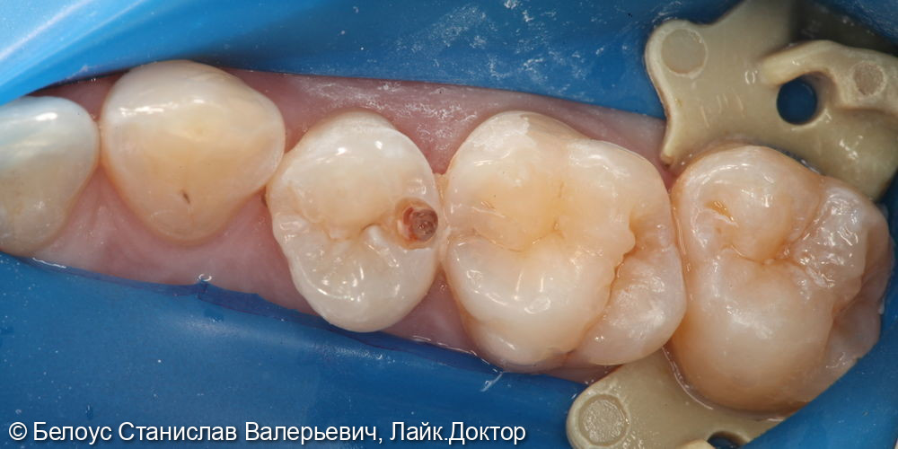 Лечение кариеса 15 и 16 зуба - фото №2