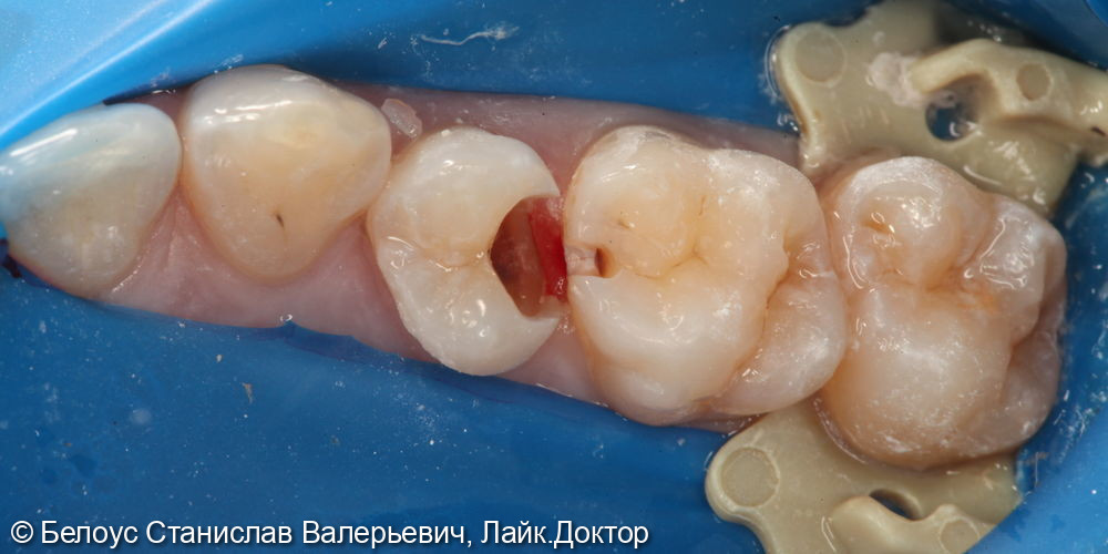 Лечение кариеса 15 и 16 зуба - фото №3
