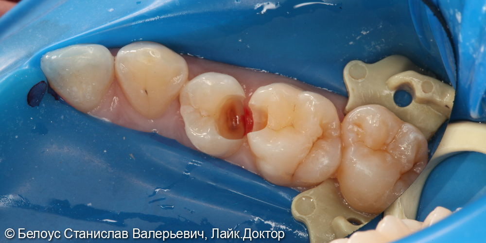 Лечение кариеса 15 и 16 зуба - фото №4