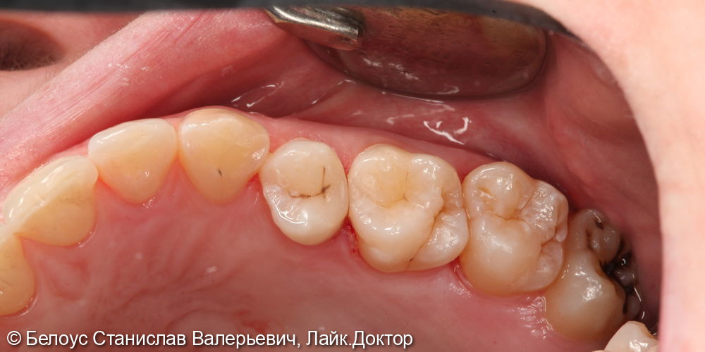 Лечение кариеса 15 и 16 зуба - фото №5
