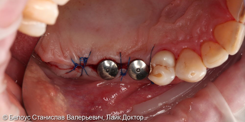 Установка имплантов в области 1.5,1.6,1.7 зуба - фото №6