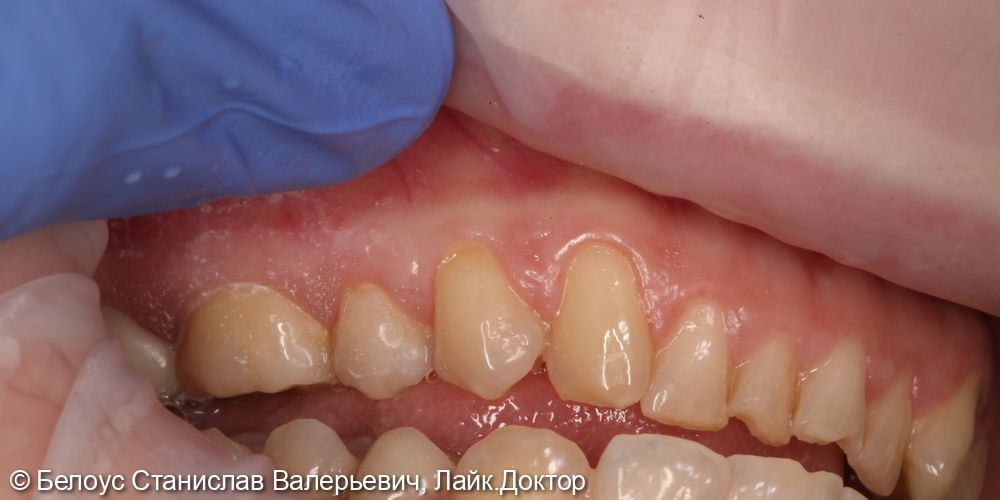 Лечение клиновидного дефекта в 3.4 и 3.5 зубах - фото №1