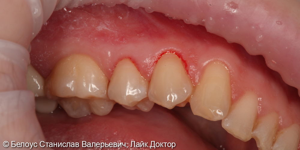 Лечение клиновидного дефекта в 3.4 и 3.5 зубах - фото №2