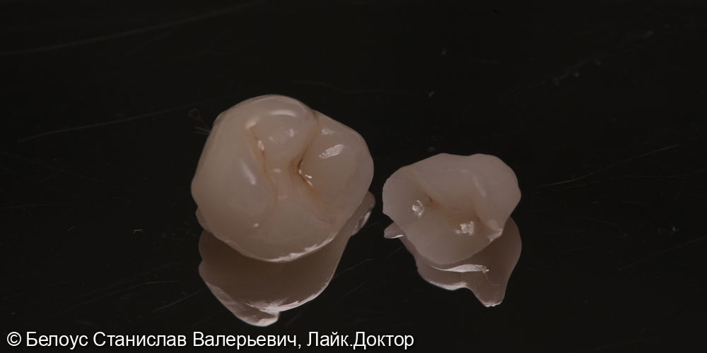 Установка керамических коронок CAD/CAM фото 3 · Ульяновск