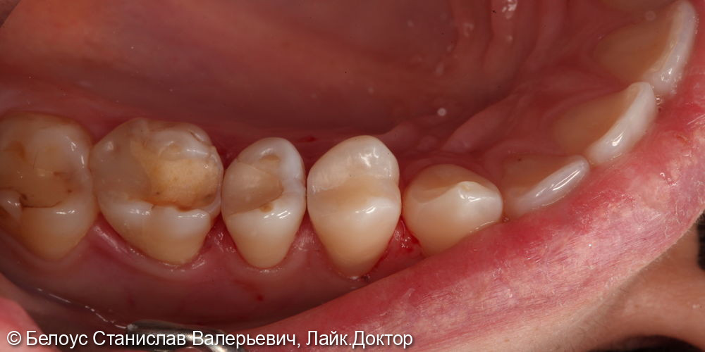 Лечение кариеса на 1.4 зубе - фото №4