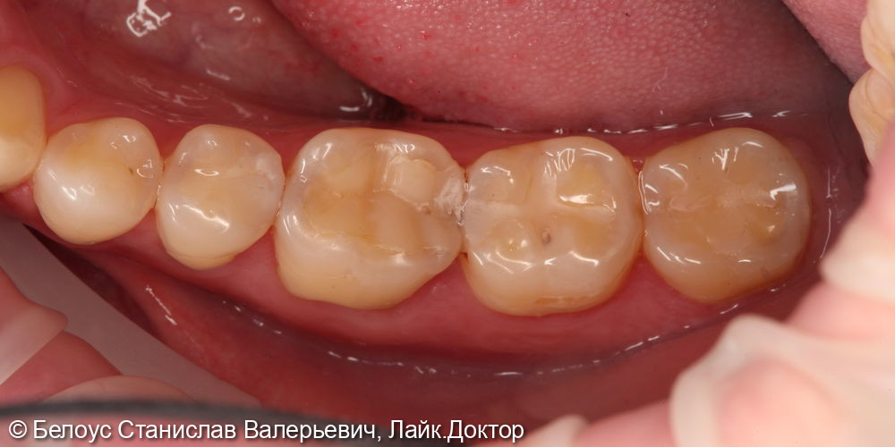 Восстановление зуба CAD/CAM коронкой 4.5,4.6.4.7 зубов - фото №1