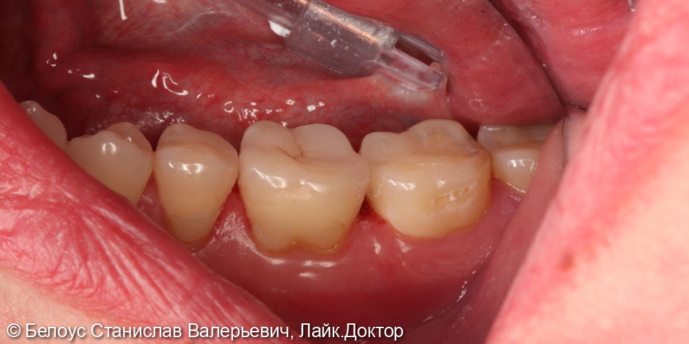 Восстановление зуба CAD/CAM коронкой 4.5,4.6.4.7 зубов - фото №5