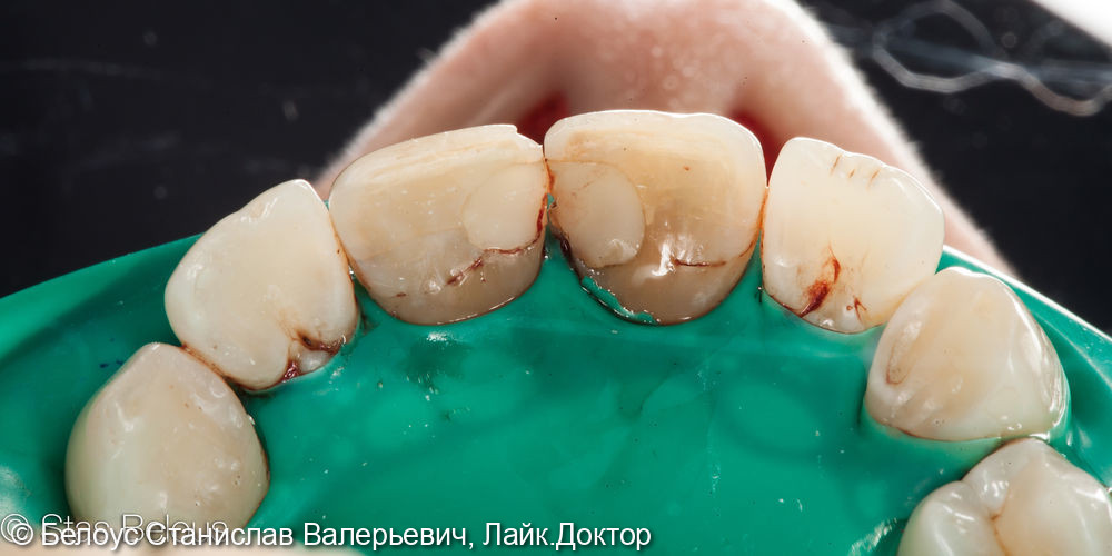 Лечение каналов в 1.1 и 2.1 зубах - фото №1