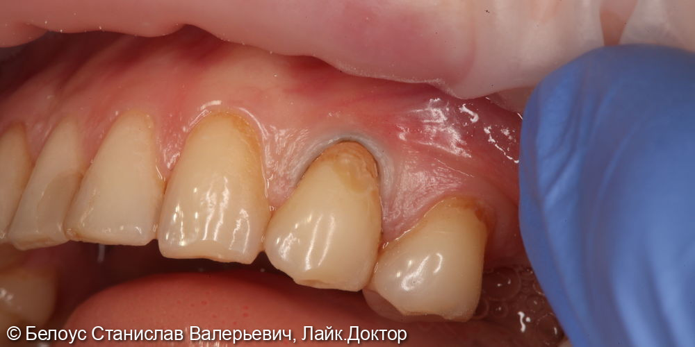 Лечение клиновидного дефекта в 4.4 зубе - фото №1