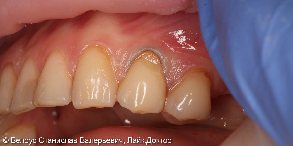 Лечение клиновидного дефекта в 4.4 зубе - фото №2