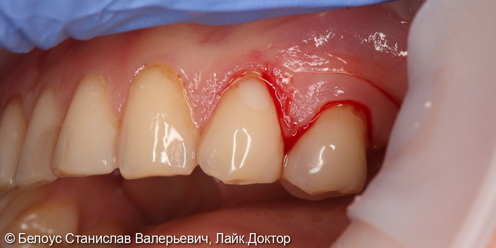 Лечение клиновидного дефекта в 4.4 зубе - фото №3