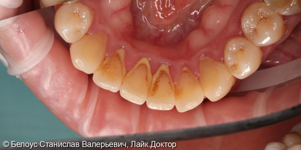 Гигиена полости рта и зубов - фото №1